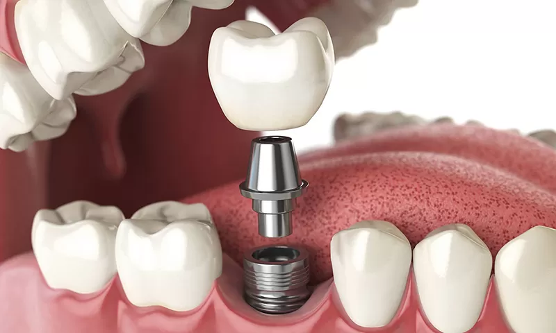 Implantes Dentários